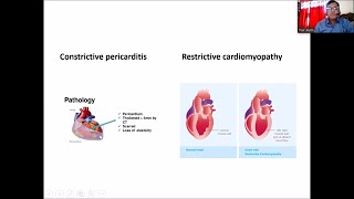 Constrictive Pericarditis amp Restrictive Cardiomyopathy by Dr Nur Alam sir [upl. by Lilak]