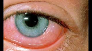 allergic conjunctivitis [upl. by Noned]