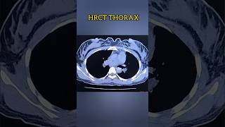 HRCT CHEST medicalimaging [upl. by Hans]