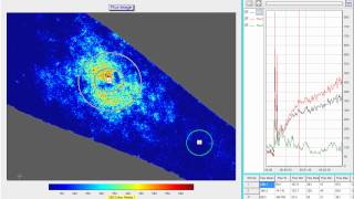 Wheal flare and axon reflex response from intradermal injection [upl. by Erick164]