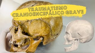 Caso clínico Traumatismo cranioencefálico grave [upl. by Anirat80]