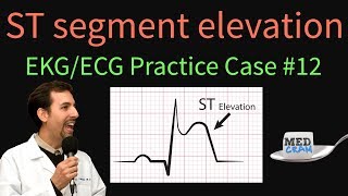 ST Elevation  EKG  ECG Interpretation Case 12 STEMI MI ACS [upl. by Elberfeld823]