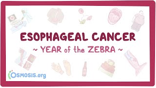 Esophageal Cancer Year of the Zebra [upl. by Ayala920]