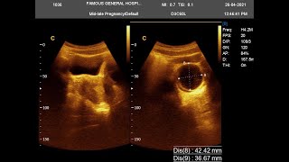 Hemorrhagic cyst USG Report with Thickened Endometrium [upl. by Auhsaj535]