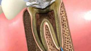 Traitement canal dentaire et pose dun inlaycore [upl. by Aira]