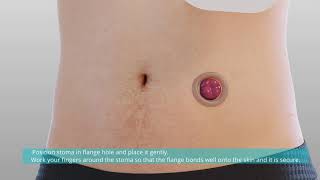 Confort Colostomy Ileostomy Bag Application Video [upl. by Assirod961]