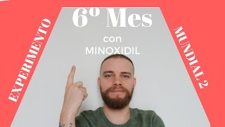 6º Meses con Minoxidil Experimento Mundial 2 [upl. by Tiana881]