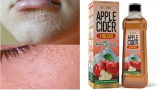 GET RID OF MILIA USING APPLE CIDER VINEGAR AT HOMEShimmeringShraddha [upl. by Kanter]