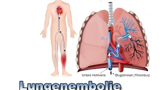 Lungenembolie  Krankheiten der Blutgefäße  Pflege Kanal [upl. by Porta]