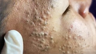 Blackheads amp Whiteheads Satisfying Removal 0033 [upl. by Arv538]