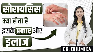 Psoriasis Symptoms Causes and Treatment  Psoriasis Treatment  Dr Bhumika [upl. by Jehius]