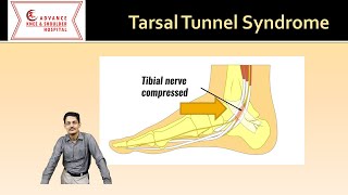 Tarsal tunnel syndrome Everything you need to know [upl. by Anali906]