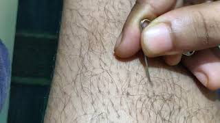 ODDLY SATISFYING removal of ingrown hair from the leg MUST WATCH [upl. by Nrubliw]