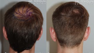 Haartransplantation Haarbepflanzung mit FUE  Tonsur  2267 Grafts [upl. by Batish]