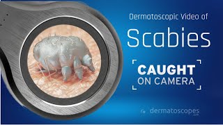 Dermoscopy of Crusted Scabies [upl. by Nosyaj431]