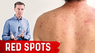 Why Red Spots on My Skin – DrBerg on Skin Red Spots Causes amp Remedies [upl. by Ydnak]