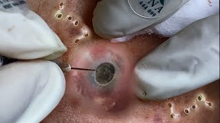 Big Cystic Acne Blackheads Extraction Blackheads amp Milia Whiteheads Removal Pimple Popping 094 [upl. by Boser]