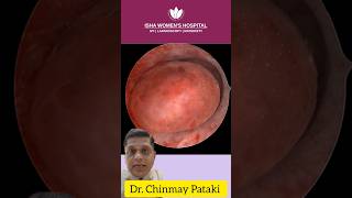 Endometrial Polyp surgery  DrChinmay Pataki  Isha Women’s Hospital  polypterus [upl. by Ennahtebazile281]