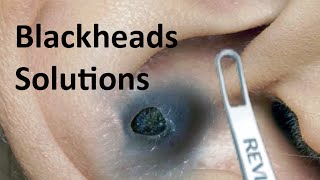 Unmasking Monster Blackheads Facts and Solutions  Facts About Monster Blackheads in Ear [upl. by Terrijo]