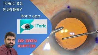 Maximizing TORIC IOL accuracy using the iTORIC app Dr Zain Khatib [upl. by Ecnirp]