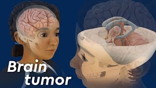 What is Craniopharyngioma [upl. by Rahcir45]