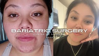 Bariatric surgery cleared my hormonal acne [upl. by Manville]