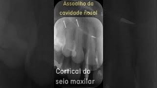 Anatomia radiográfica intrabucal  Região de incisivo lateral e canino superiores [upl. by Zebaj]