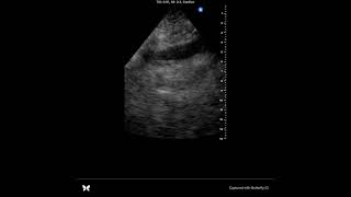 POCUS tamponade case [upl. by Merrill971]