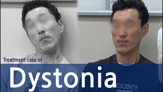 Cervical Dystonia  Dystonia  Spasmodic Torticollis  Dysphonia  사경증 치료사례  근긴장이상증 [upl. by Nalda365]