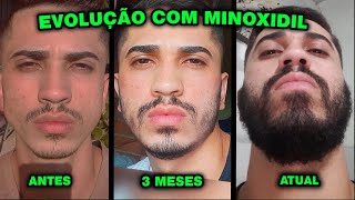 2 ANOS E 10 MESES usando MINOXIDIL Kirkland e Foligain [upl. by Brunhilda]