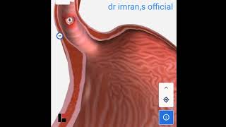 Esophegial squamus cell carcinoma [upl. by Noe703]