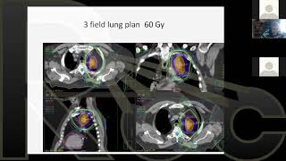 2D to 3D EBRT  Session 15  Evaluating Normal Tissue Constraints and Plans for Treatment [upl. by Baird701]