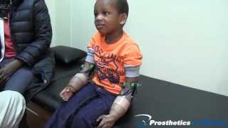 3yr old Bilateral Below Elbow Amputee receives 1st MyoElectric Prostheses [upl. by Noelopan482]