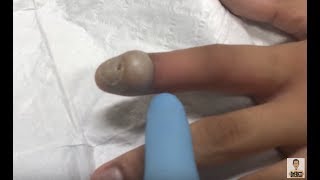 large infected bump on finger [upl. by Wenn]