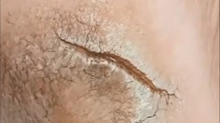 Pedicure video35，A large tear in the heel，vertical plantaris，plantar wart [upl. by Aidnac476]