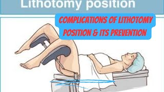 complications of lithotomy position amp its prevention obgyneLearning [upl. by Bee]