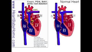 44 Coarctation of the Aorta bicuspid aortic aortic root dilation [upl. by Yeslaehc]