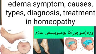 what is edema symptom causes types diagnosis treatment in homeopathy medicine [upl. by Enileuqkcaj]