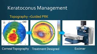 Keratoconus Management Corneal Crosslinking amp TopographyGuided PRK at Bochner Eye in Toronto [upl. by Lanny]