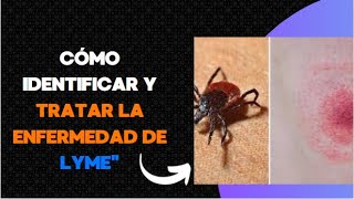 Cómo Identificar y Tratar la Enfermedad de Lymequot [upl. by Werd]