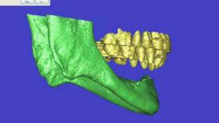 CT Scan Video For Dental Implants [upl. by Enamrahc]