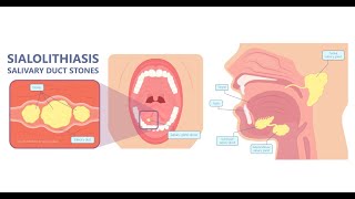 Why formation of calculus  Sialolithiasis is more common in submandibular than in parotid glands [upl. by Oirogerg]