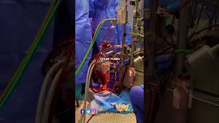 Perfusion aspects by a clinical Perfusionist perfusion nurse [upl. by Sparky843]