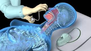 Nasotracheal suctioning NTS  3D animation [upl. by Gylys881]