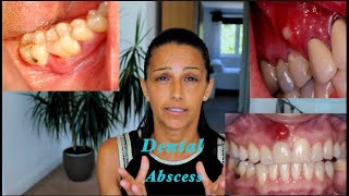 How to treat a Dental Abscess Different Natural Mouthrinses and their uses [upl. by Adnov734]