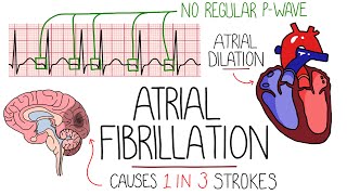 Atrial Fibrillation Made Easy Complete Overview [upl. by Howlyn]