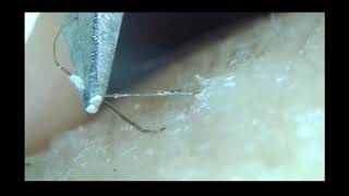 Ingrown Leg Hair [upl. by Niple]