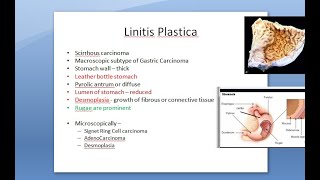 Pathology 521 d Linitis Plastica scirrhous carcinoma stomach leather bottle cancer Signet ring [upl. by Nuajed]