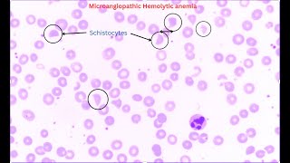 Microangiopathic hemolytic anemia [upl. by Yecrad510]