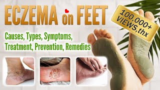 Eczema on foot Causes Symptoms Types Treatment Prevention and Home Remedies  Feet Eczema [upl. by Corwun]